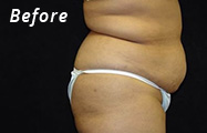 Tummy Tuck Before Plastic Surgery Photo Maryland