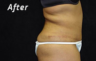 Tummy Tuck After Plastic Surgery Photo Maryland
