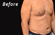 Abdominal Etching Before Plastic Surgery Photo Maryland