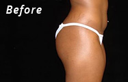 Brazilian Butt Lift Before Plastic Surgery Photo Maryland