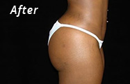 Brazilian Butt Lift After Plastic Surgery Photo Maryland