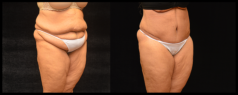 Patient #433 Lower Body Lift Before and After Photos Baltimore