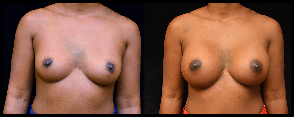 Breast Augmentation Before & After Patient #1013