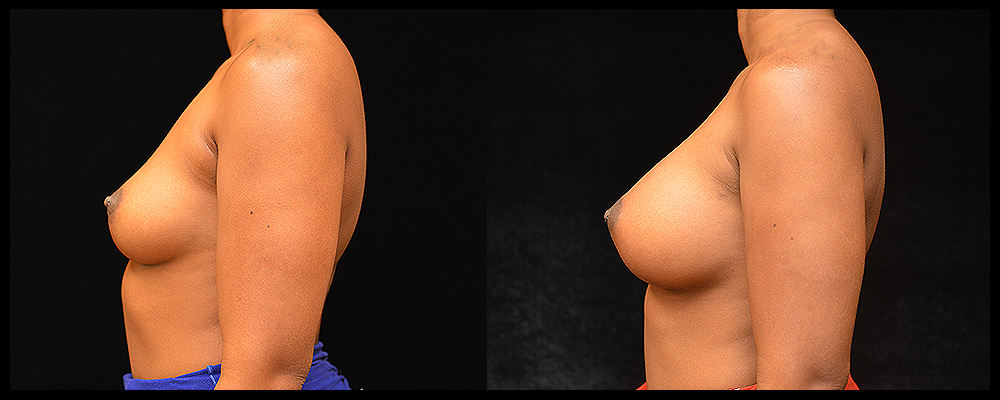 Breast Augmentation Before & After Patient #1013