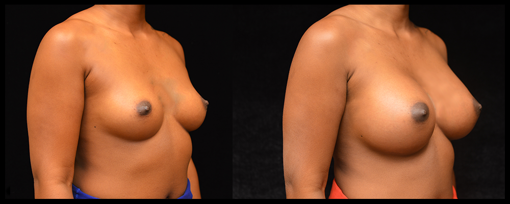 Breast Augmentation Before & After Patient #1013