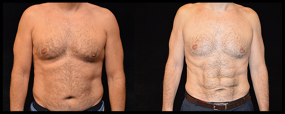 Six Pack Abs Before & After Patient #1153