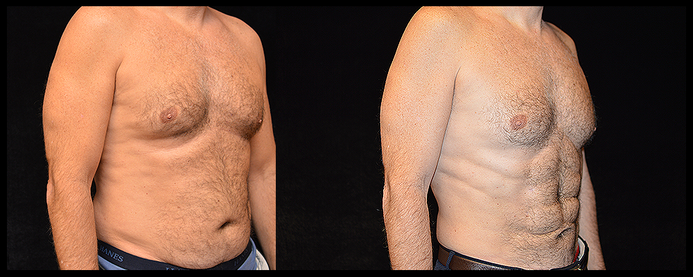 Six Pack Abs Before & After Patient #1153