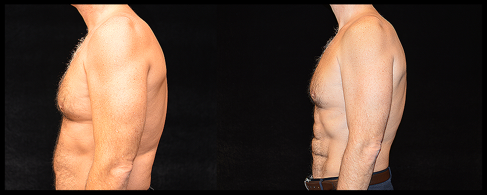 Six Pack Abs Before & After Patient #1153