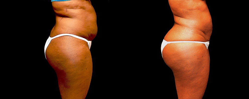 Liposuction Before & After Patient #410