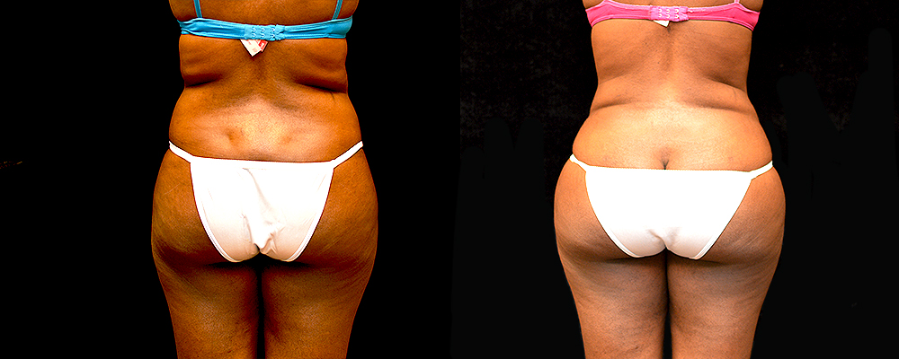 Liposuction Before & After Patient #410