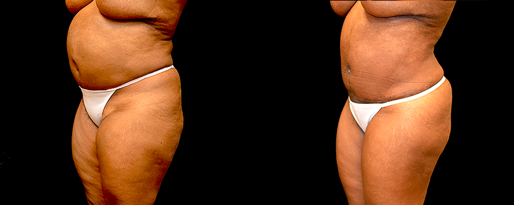 Liposuction Before & After Patient #290