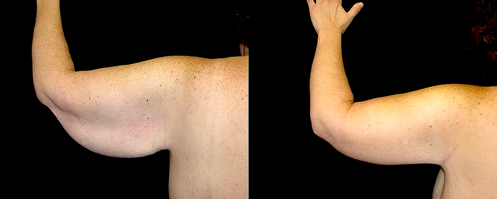 Arm Lift Before & After Patient #261