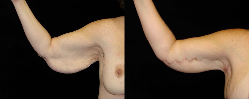 Arm Lift Before & After Patient #261