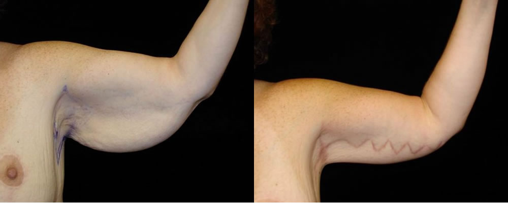 Arm Lift Before & After Patient #261