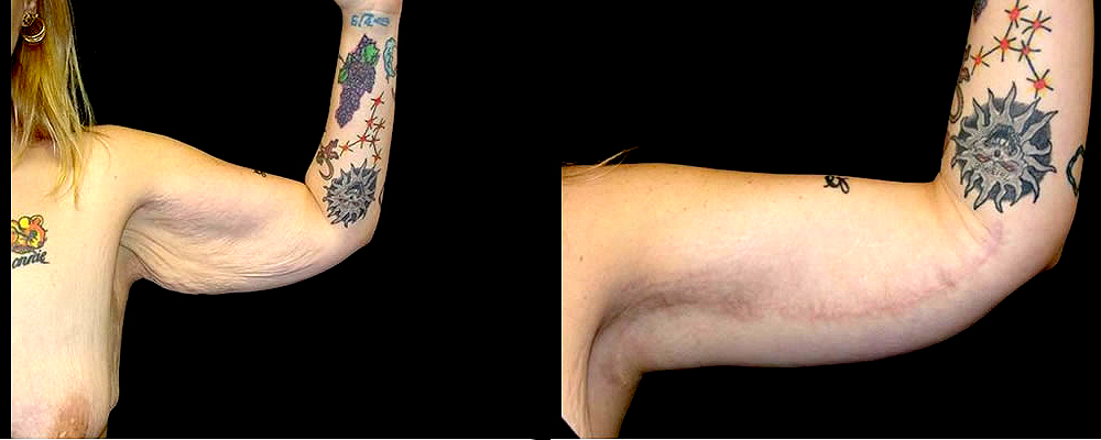 Arm Lift Before & After Patient #254