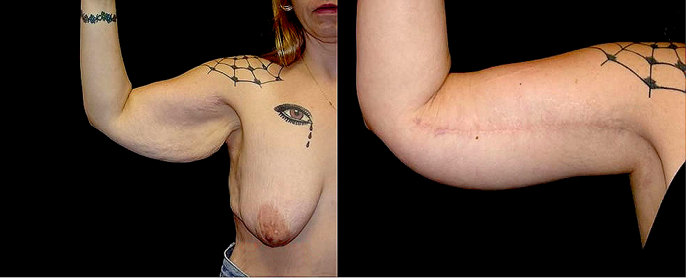 Arm Lift Before & After Patient #254