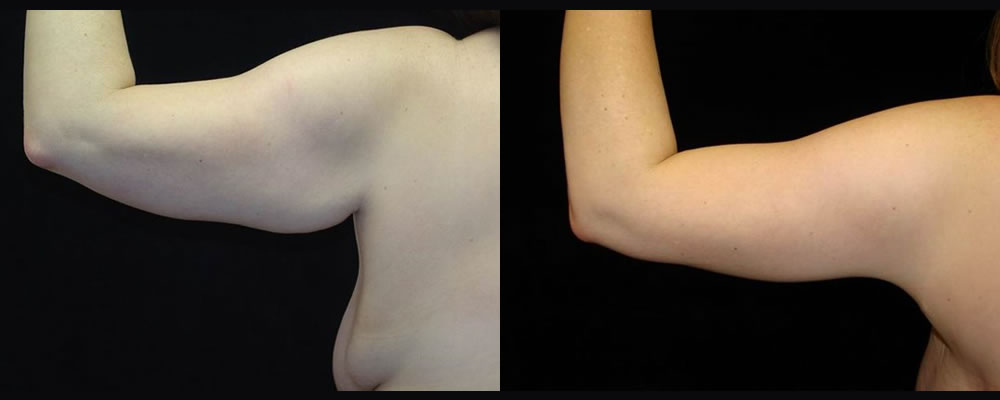 Arm Lift Before & After Patient #245