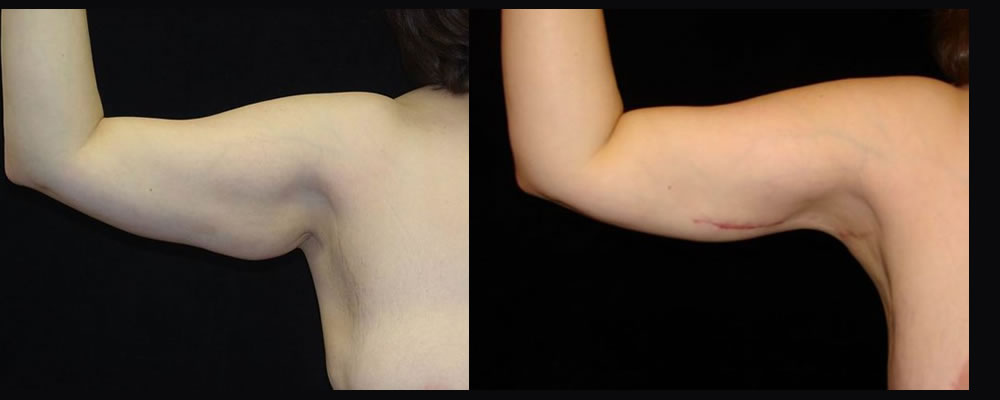 Arm Lift Before & After Patient #245