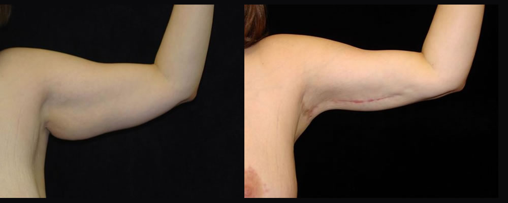 Arm Lift Before & After Patient #245