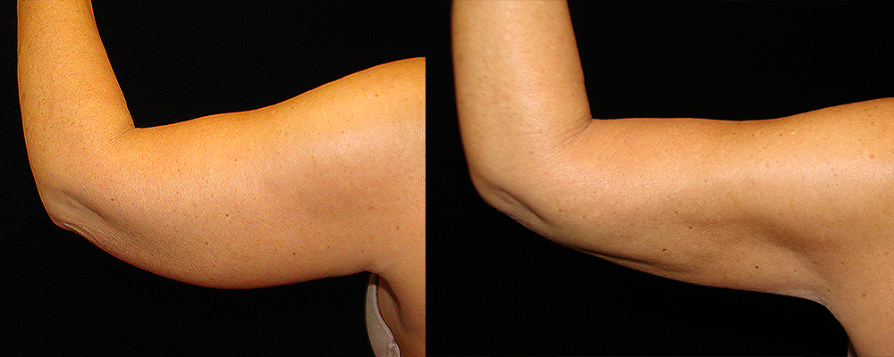 Arm Lift Before & After Patient #239