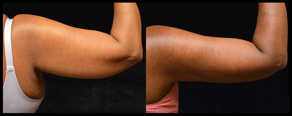 Arm Lift Before & After Patient #236