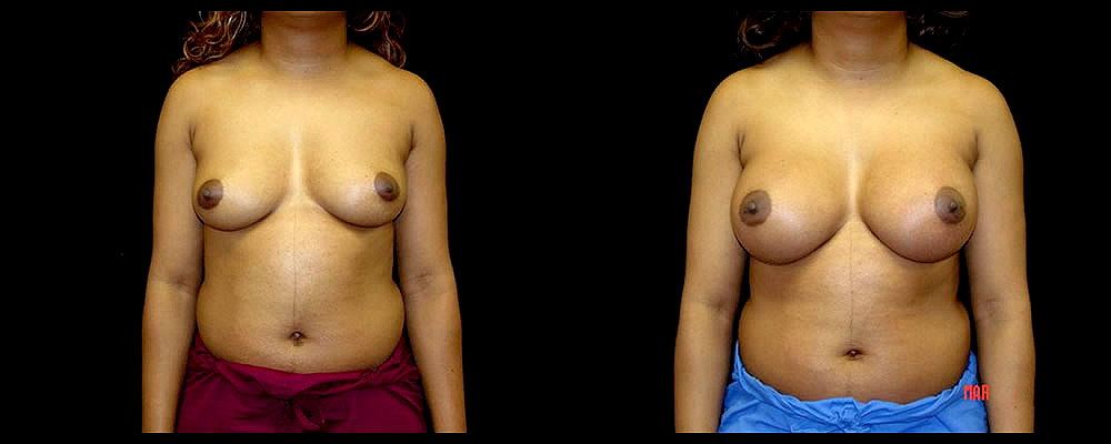 Breast Augmentation Before & After Patient #988