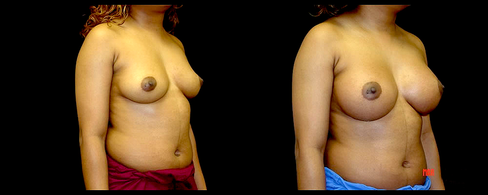 Breast Augmentation Before & After Patient #988