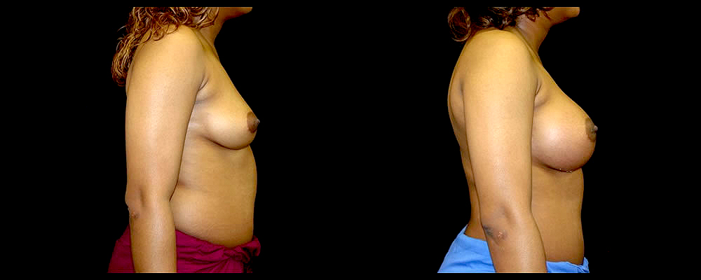 Breast Augmentation Before & After Patient #988