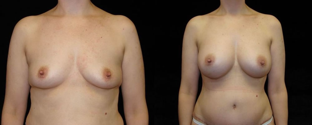 Breast Augmentation Before & After Patient #948