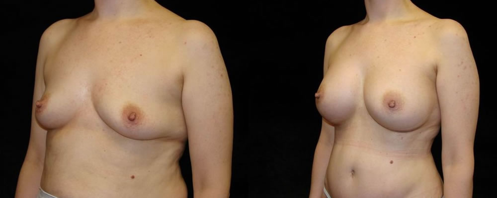 Breast Augmentation Before & After Patient #948