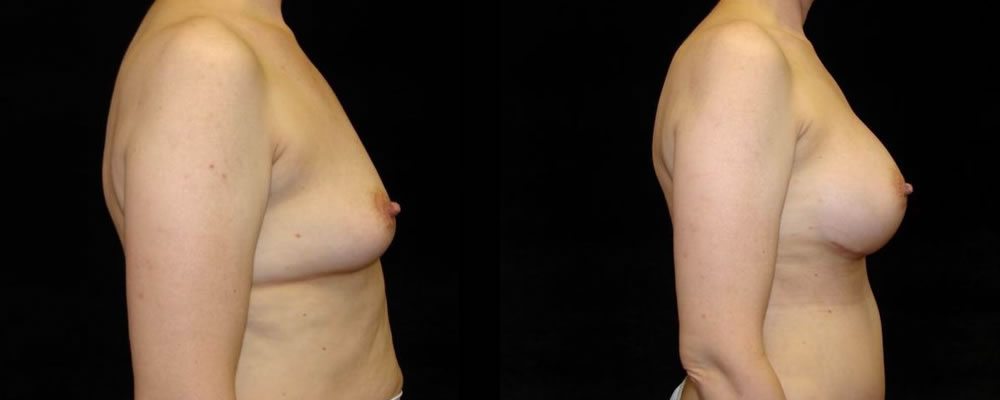 Breast Augmentation Before & After Patient #948