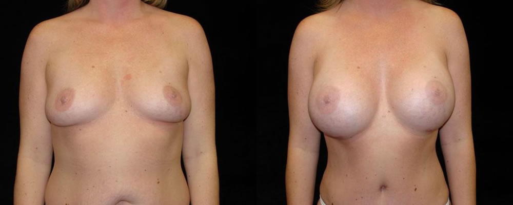 Breast Augmentation Before & After Patient #944