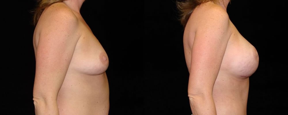 Breast Augmentation Before & After Patient #944