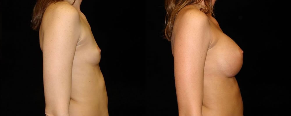 Breast Augmentation Before & After Patient #941