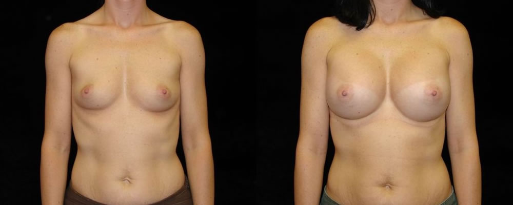 Breast Augmentation Before & After Patient #933