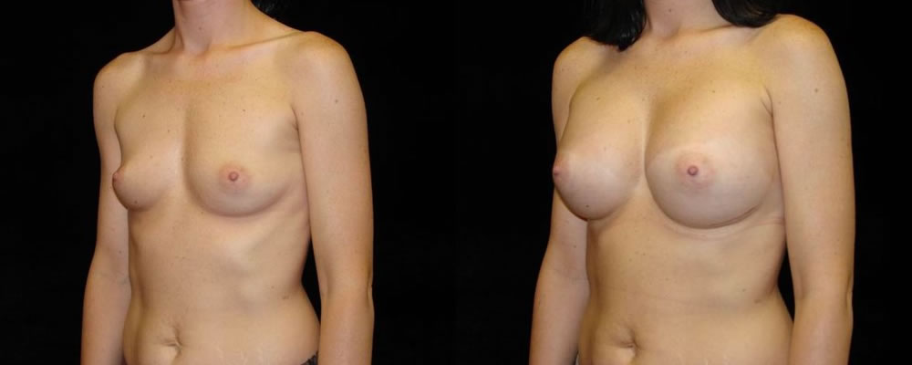 Breast Augmentation Before & After Patient #933