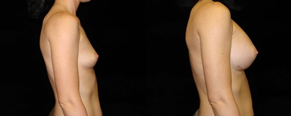 Breast Augmentation Before & After Patient #933