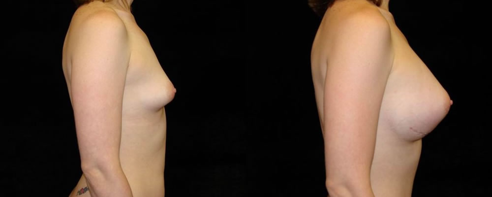 Breast Augmentation Before & After Patient #929