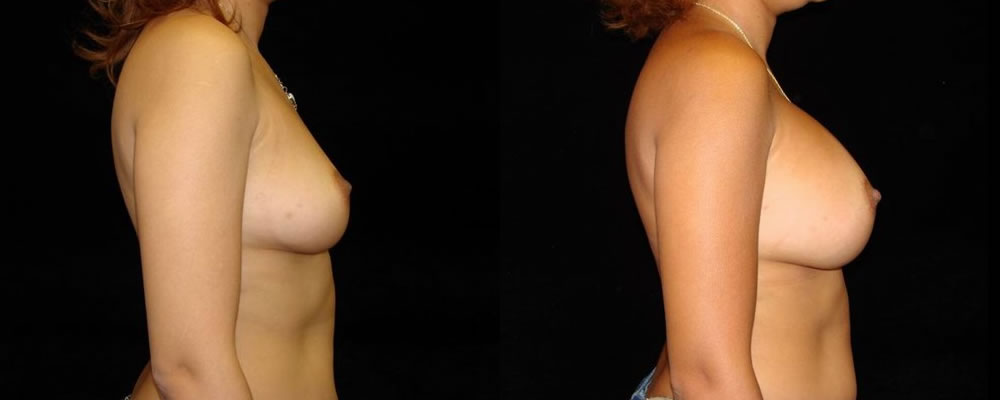 Breast Augmentation Before & After Patient #925