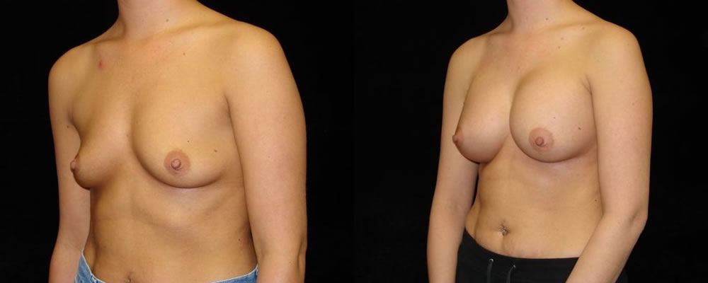 Breast Augmentation Before & After Patient #921