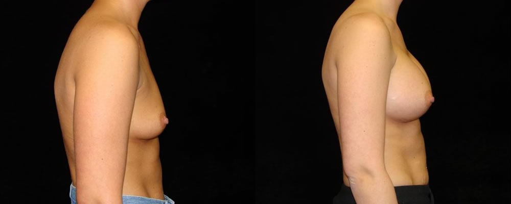 Breast Augmentation Before & After Patient #921