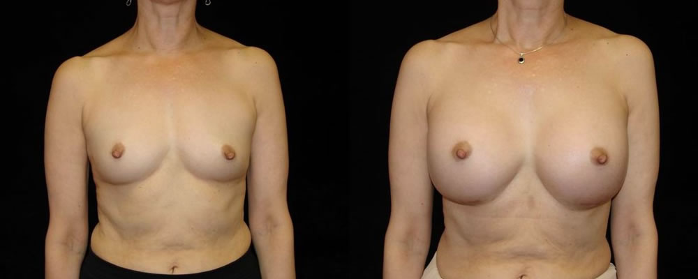 Breast Augmentation Before & After Patient #917