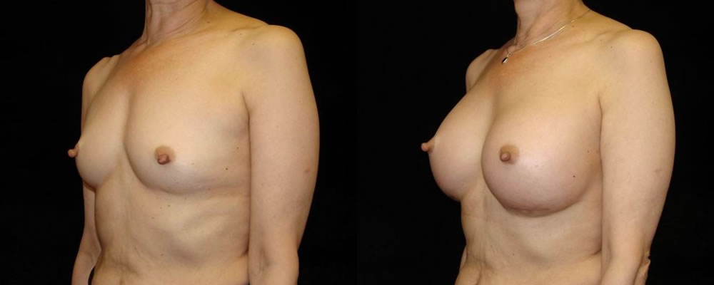 Breast Augmentation Before & After Patient #917