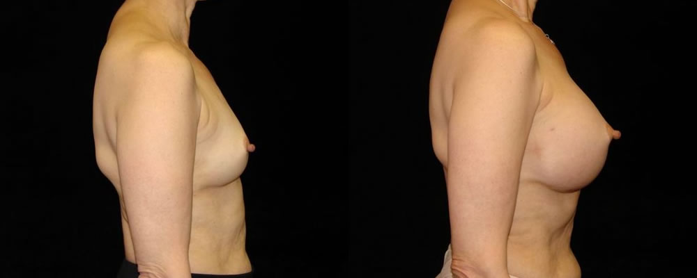 Breast Augmentation Before & After Patient #917