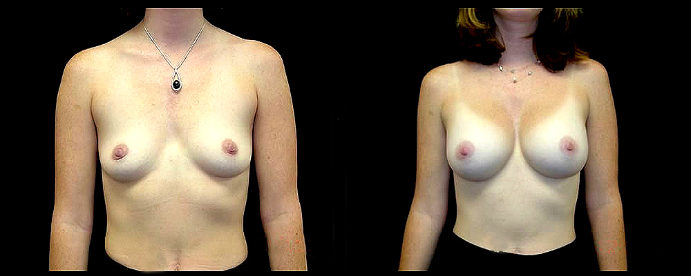 Breast Augmentation Before & After Patient #984