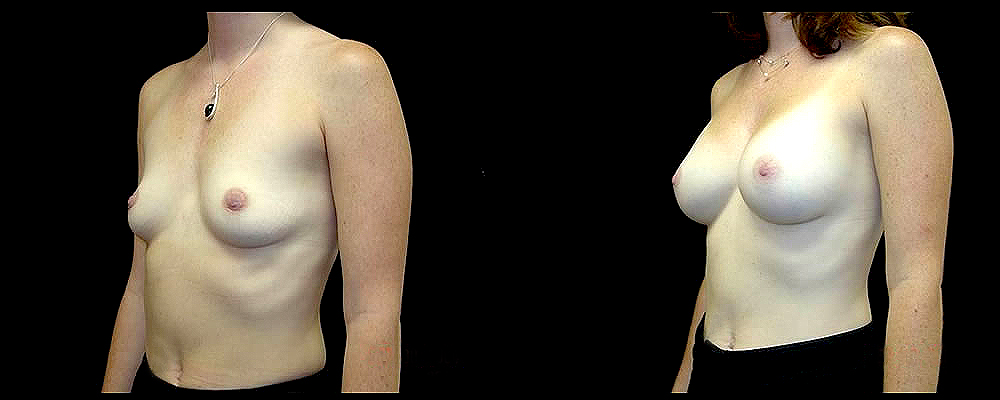 Breast Augmentation Before & After Patient #984