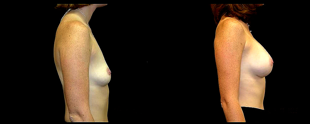 Breast Augmentation Before & After Patient #984
