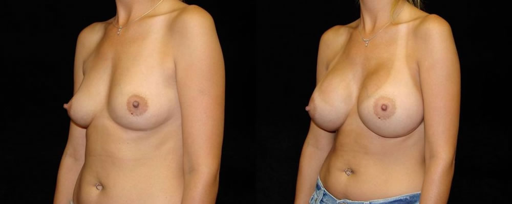 Breast Augmentation Before & After Patient #913