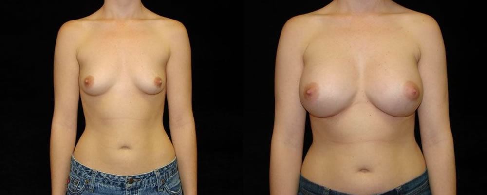 Breast Augmentation Before & After Patient #909
