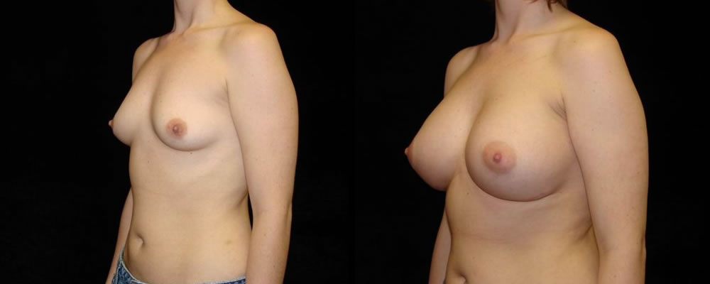 Breast Augmentation Before & After Patient #909